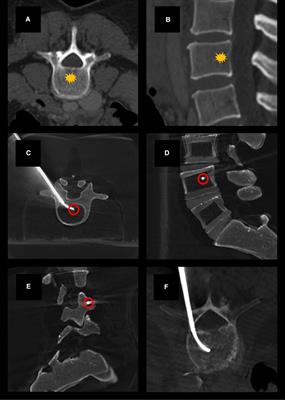 Case report: Basivertebral nerve block during vertebral augmentation: an alternative approach to intraprocedural pain management